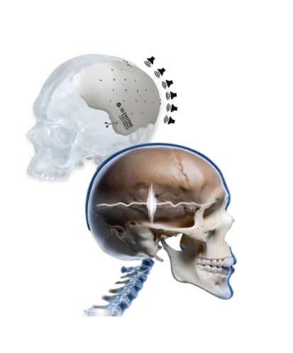 Transcranial focused ultrasound via metamaterial engineering